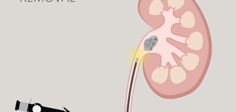 Best Kidney Stone Doctor in Old Gurgaon